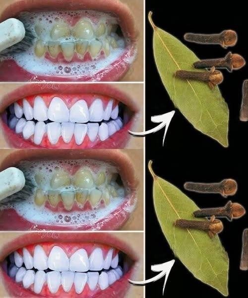 Como Remover o Tártaro e Clarear os Dentes